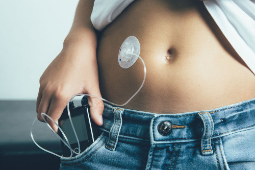 Close up photo of an insulin pump unit in a woman's jean's pocket with a tube attached to her belly. 