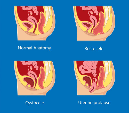 Illustration showing a cross section of a normal female pelvis and three others showing uterine, rectal and bladder prolapse. 